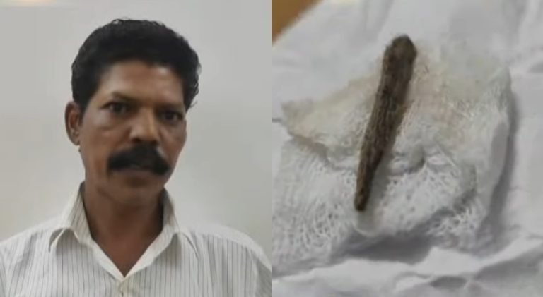 ചികിത്സാപ്പിഴവ്; തുന്നിക്കെട്ടിയ മുറിവില്‍ നിന്ന് 5 മാസത്തിന് ശേഷം മരച്ചീള് കണ്ടെത്തി