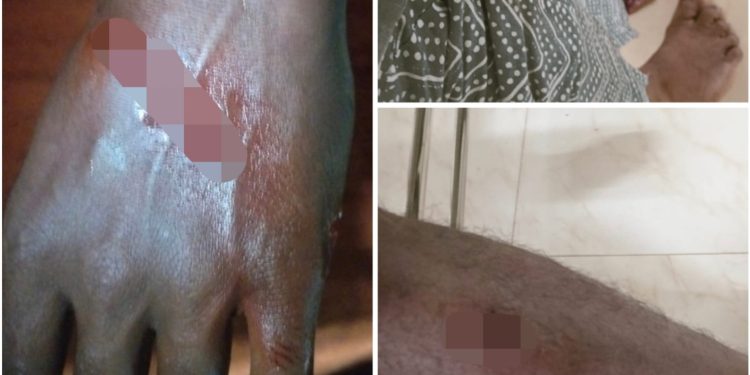 പൊഴുതനയിൽ വീണ്ടും തെരുവുനായ ആക്രമണം