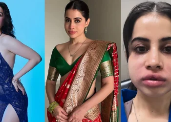 ‘ഫില്ലറുകള്‍ പണി തന്നു, മുഖവും ചുണ്ടും നീരുവച്ച് വീര്‍ത്തു’; തലവേദന അസഹനീയമെന്ന് ഉര്‍ഫി