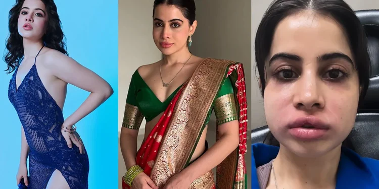 ‘ഫില്ലറുകള് പണി തന്നു, മുഖവും ചുണ്ടും നീരുവച്ച് വീര്ത്തു’; തലവേദന അസഹനീയമെന്ന് ഉര്ഫി