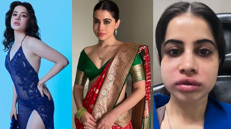 ‘ഫില്ലറുകള്‍ പണി തന്നു, മുഖവും ചുണ്ടും നീരുവച്ച് വീര്‍ത്തു’; തലവേദന അസഹനീയമെന്ന് ഉര്‍ഫി