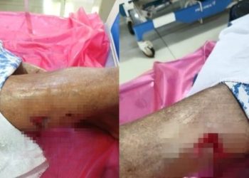 തെരുവുനായയുടെ ആക്രമണത്തിൽ വയോധികക്ക് ഗുരുതര പരിക്ക്