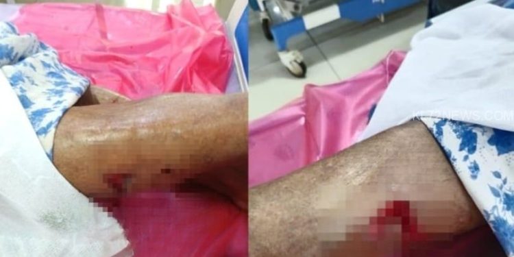 തെരുവുനായയുടെ ആക്രമണത്തിൽ വയോധികക്ക് ഗുരുതര പരിക്ക്