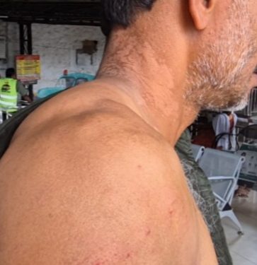 തെരുവുനായ ആക്രമണം: മധ്യവയസ്കന് പരിക്ക്