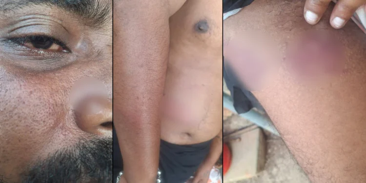 ലാത്തി കൊണ്ട് കണ്ണിലും വയറ്റിലും പുറത്തും അടി, കാഴ്ചയ്ക്കു മങ്ങൽ; ആളുമാറി യുവാവിന് കസ്റ്റഡി മർദനം