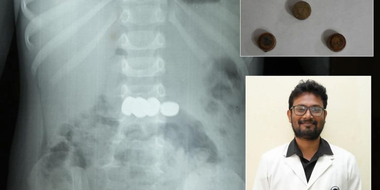 രണ്ട് വയസ്സുകാരൻ വിഴുങ്ങിയ അഞ്ച് ബാറ്ററികൾ എൻഡോസ്കോപ്പിയിലൂടെ സുരക്ഷിതമായി പുറത്തെടുത്തു