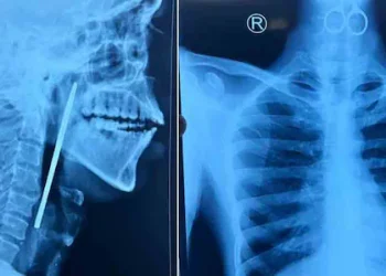 ഗവ. മാനസികാരോഗ്യ കേന്ദ്രത്തിലെ രോഗി കത്രിക വിഴുങ്ങി; അടിയന്തിര ശസ്ത്രക്രിയയിലൂടെ പുറത്തെടുത്തു