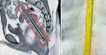 കാൽമുട്ടു വേദനയുമായി ആശുപത്രിയിലെത്തി; ചികിത്സയ്ക്കിടെ ‘ട്വിസ്റ്റ്’: ‘കാണാതായ’ പെൻസിൽ ശസ്ത്രക്രിയയിലൂടെ പുറത്തെടുത്തു