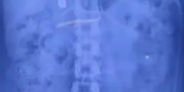 കുഞ്ഞിനെ ലാളിക്കുന്നതിനിടെ സ്വര്‍ണമാല വിഴുങ്ങി; യുവതി പിടിയില്‍