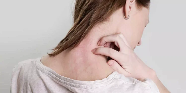 വേനൽക്കാലത്തെ ചൂടുകുരു മാറ്റാൻ പൗഡർ വേണ്ട; ഇതാ ഒരു ‘കൂൾ’ പ്ലാൻ