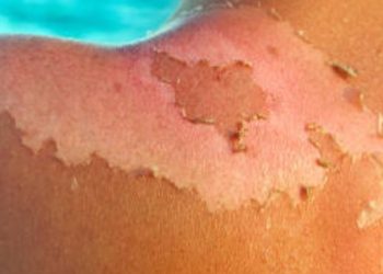 പതിമൂന്നുകാരന് സൂര്യാതപമേറ്റു: സംഭവം ബത്തേരിയിൽ