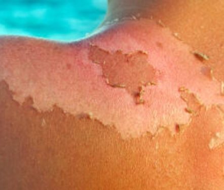 പതിമൂന്നുകാരന് സൂര്യാതപമേറ്റു: സംഭവം ബത്തേരിയിൽ