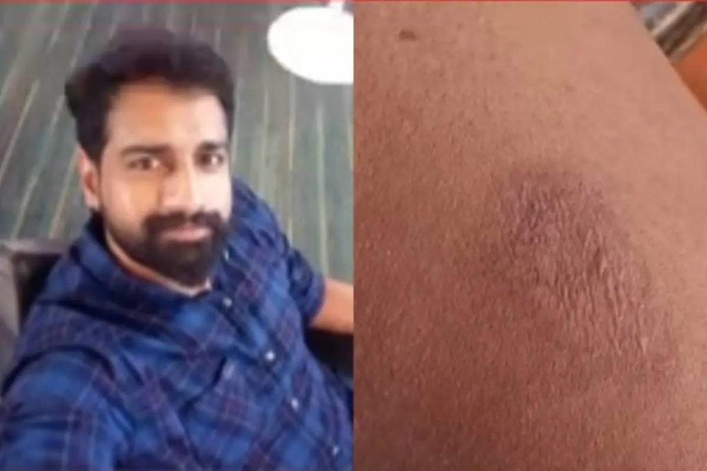 കിണർപണിക്കിടെ സൂര്യാഘാതം; കണ്ണൂരിൽ യുവാവ് മരിച്ചു, കോഴിക്കോട്ട് അങ്കണവാടി ജീവനക്കാരിക്ക് പൊള്ളൽ