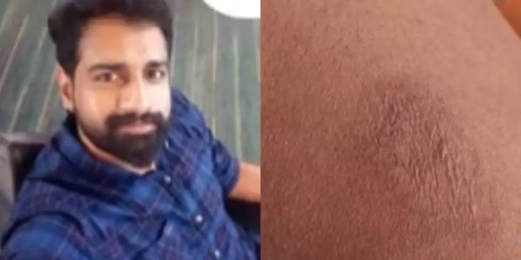 കിണർപണിക്കിടെ സൂര്യാഘാതം; കണ്ണൂരിൽ യുവാവ് മരിച്ചു, കോഴിക്കോട്ട് അങ്കണവാടി ജീവനക്കാരിക്ക് പൊള്ളൽ